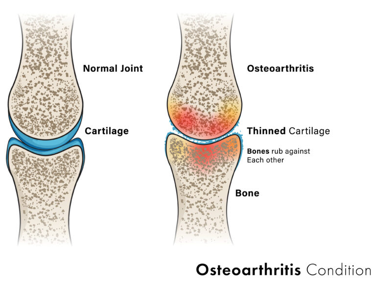 Issue #65: Don’t let sarcopenia and joint degradation ruin your golden years