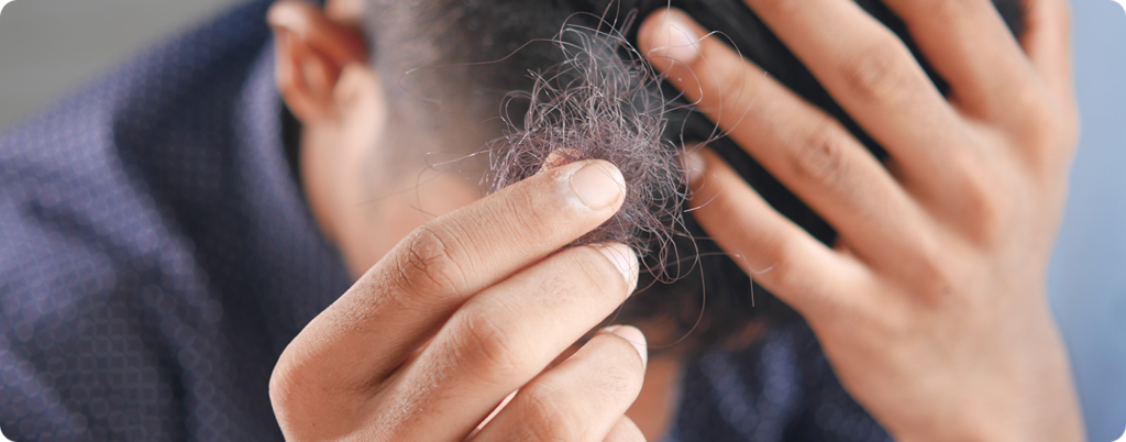 natural hair loss remedies