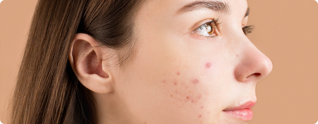Woman with acne as a result of PCOS.