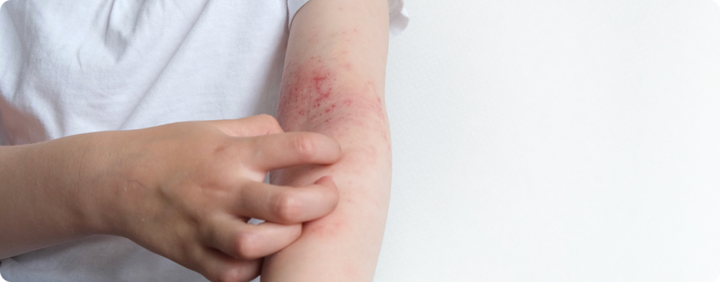 A person scratches a rash that resulted from histamine intolerance. 